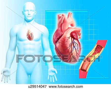 Stock Illustration - Atherosclerosis, artwork. Fotosearch