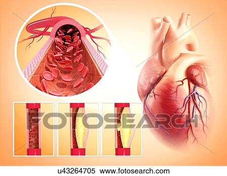 Atherosclerosis, artwork View Large Illustration Stock Illustration - Atherosclerosis, artwork. Fotosearch