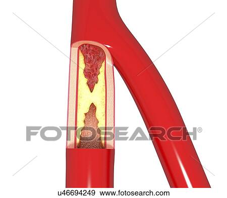 Stock Illustration - Atherosclerosis, artwork. Fotosearch