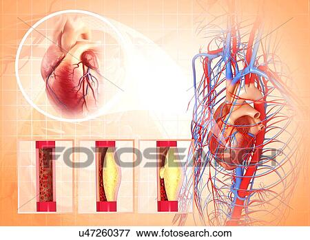 Atherosclerosis, artwork View Large Illustration Stock Illustration - Atherosclerosis, artwork. Fotosearch