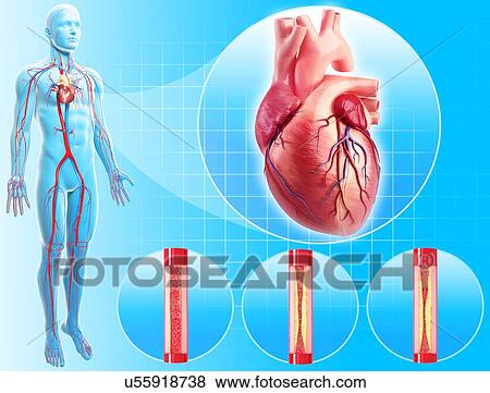 Stock Illustration - Atherosclerosis, artwork. Fotosearch