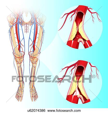 Atherosclerosis, artwork View Large Illustration Stock Illustration - Atherosclerosis, artwork. Fotosearch