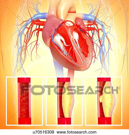 Stock Illustration - Atherosclerosis, artwork. Fotosearch