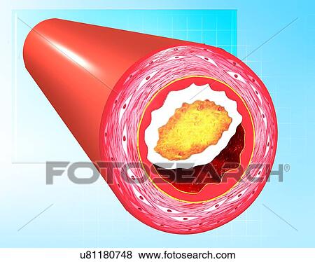 Atherosclerosis, artwork View Large Illustration Stock Illustration - Atherosclerosis, artwork. Fotosearch