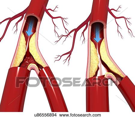 Atherosclerosis, artwork View Large Illustration Stock Illustration - Atherosclerosis, artwork. Fotosearch