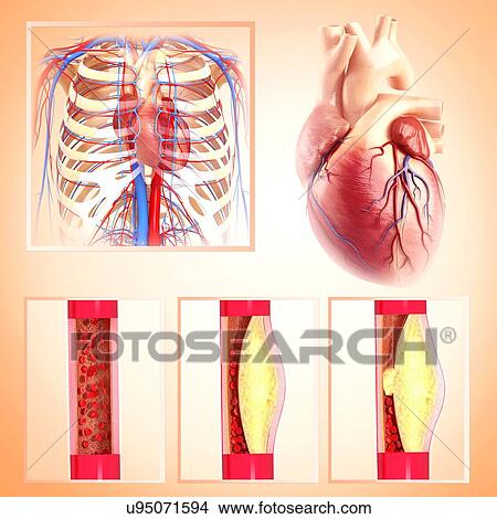 Atherosclerosis, artwork View Large Illustration Stock Illustration - Atherosclerosis, artwork. Fotosearch