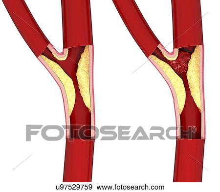 Stock Illustration - Atherosclerosis, artwork. Fotosearch