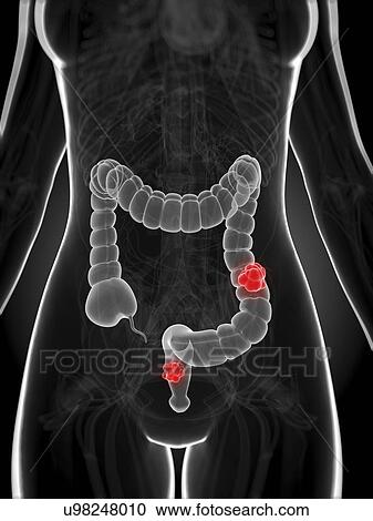 Bowel cancer, artwork View Large Illustration Clipart - Bowel cancer, artwork. Fotosearch
