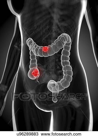 Bowel cancer, artwork View Large Illustration Drawing - Bowel cancer, artwork. Fotosearch