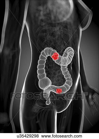 Bowel cancer, artwork View Large Illustration Stock Illustration - Bowel cancer, artwork. Fotosearch