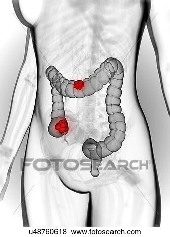 Bowel cancer, artwork View Large Illustration Stock Illustration - Bowel cancer, artwork. Fotosearch