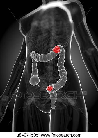 Bowel cancer, artwork View Large Illustration Stock Illustration - Bowel cancer, artwork. Fotosearch