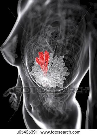 Clip Art - Breast cancer, artwork. Fotosearch