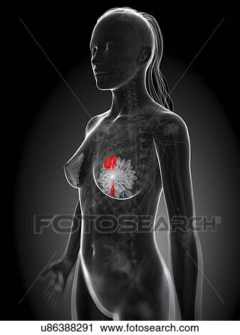 Clip Art - Breast cancer, artwork. Fotosearch