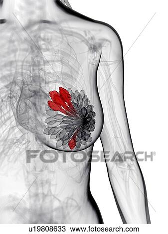 Drawing - Breast cancer, artwork. Fotosearch