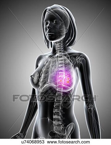 Drawing - Breast cancer, artwork. Fotosearch