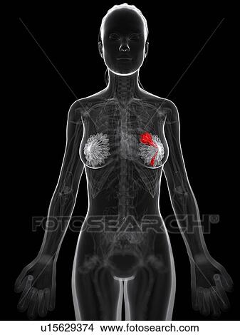 Stock Illustration - Breast cancer, artwork. Fotosearch