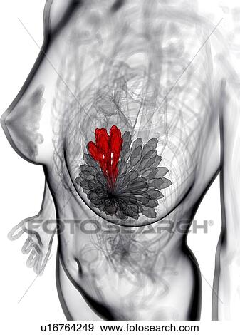 Breast cancer, artwork View Large Illustration Stock Illustration - Breast cancer, artwork. Fotosearch