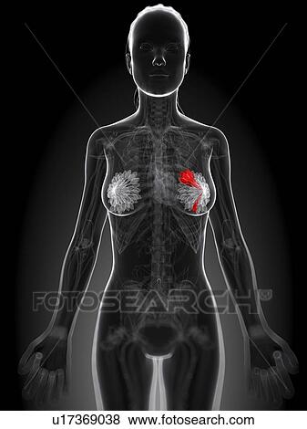 Stock Illustration - Breast cancer, artwork. Fotosearch