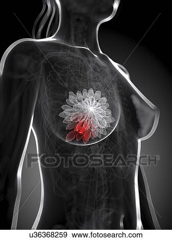 Stock Illustration - Breast cancer, artwork. Fotosearch