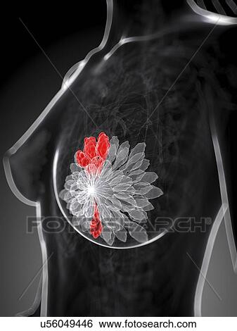 Stock Illustration - Breast cancer, artwork. Fotosearch