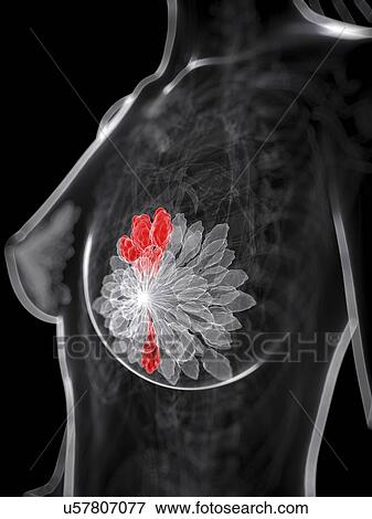Stock Illustration - Breast cancer, artwork. Fotosearch