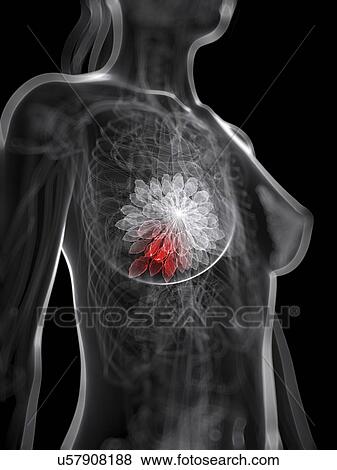 Stock Illustration - Breast cancer, artwork. Fotosearch