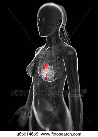 Stock Illustration - Breast cancer, artwork. Fotosearch