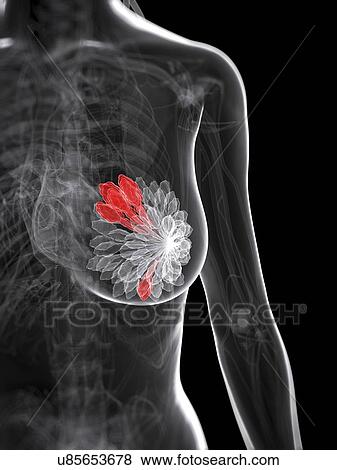 Breast cancer, artwork View Large Illustration Stock Illustration - Breast cancer, artwork. Fotosearch
