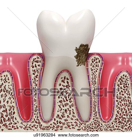 Stock Illustration - Dental plaque, artwork. Fotosearch