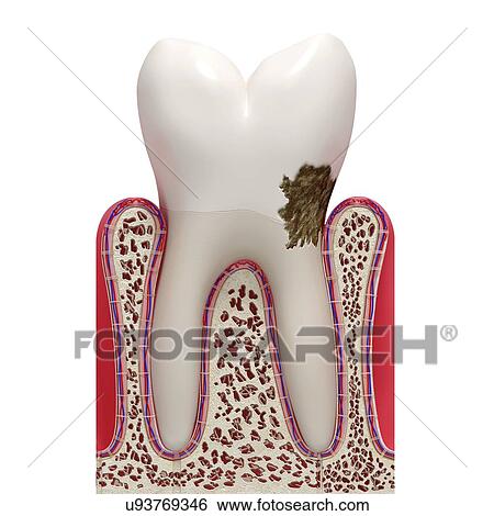 Stock Illustration - Dental plaque, artwork. Fotosearch