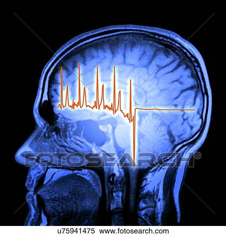 ECG trace and mri brain scan, artwork View Large Illustration Stock Illustration - ECG trace and mri brain scan, artwork. Fotosearch