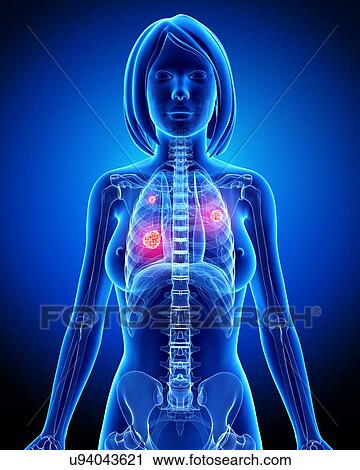 Female lung cancer, artwork View Large Illustration Clip Art - Female lung cancer, artwork. Fotosearch