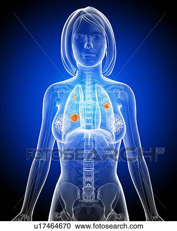 Clipart - Female lung cancer, artwork. Fotosearch