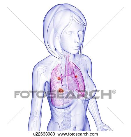 Female lung cancer, artwork View Large Illustration Clipart - Female lung cancer, artwork. Fotosearch
