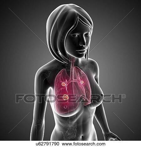 Female lung cancer, artwork View Large Illustration Clipart - Female lung cancer, artwork. Fotosearch