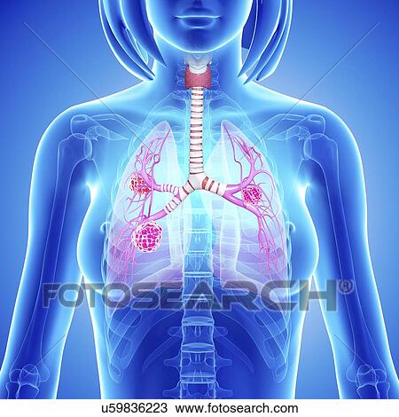 Female lung cancer, artwork View Large Illustration Drawing - Female lung cancer, artwork. Fotosearch