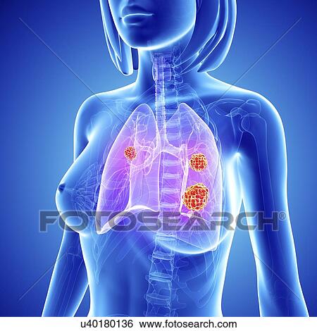 Female lung cancer, artwork View Large Illustration Stock Illustration - Female lung cancer, artwork. Fotosearch