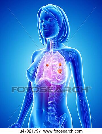 Female lung cancer, artwork View Large Illustration Stock Illustration - Female lung cancer, artwork. Fotosearch