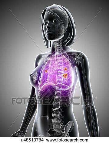 Female lung cancer, artwork View Large Illustration Stock Illustration - Female lung cancer, artwork. Fotosearch