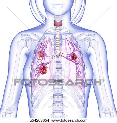 Stock Illustration - Female lung cancer, artwork. Fotosearch