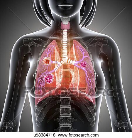 Female lung cancer, artwork View Large Illustration Stock Illustration - Female lung cancer, artwork. Fotosearch
