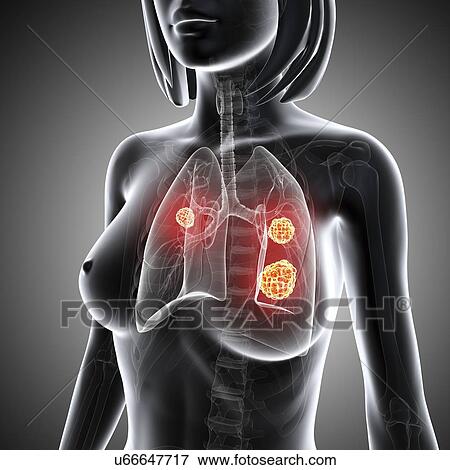 Female lung cancer, artwork View Large Illustration Stock Illustration - Female lung cancer, artwork. Fotosearch