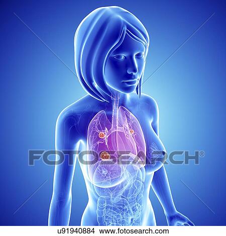 Female lung cancer, artwork View Large Illustration Stock Illustration - Female lung cancer, artwork. Fotosearch