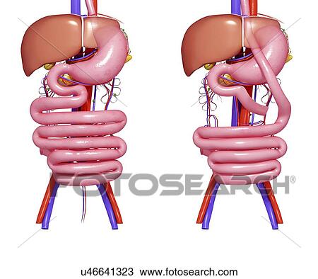Gastric bypass, artwork View Large Illustration Drawing - Gastric bypass, artwork. Fotosearch