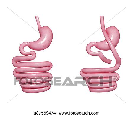 Gastric bypass, artwork View Large Illustration Stock Illustration - Gastric bypass, artwork. Fotosearch