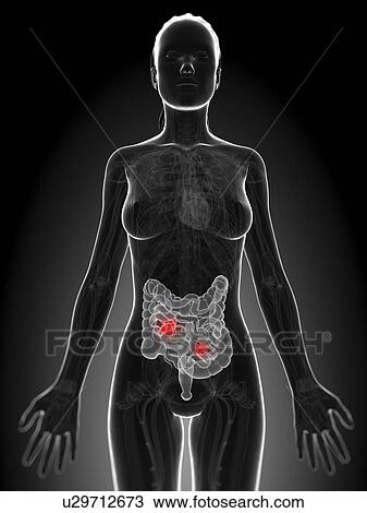 Intestinal cancer, artwork View Large Illustration Drawing - Intestinal cancer, artwork. Fotosearch