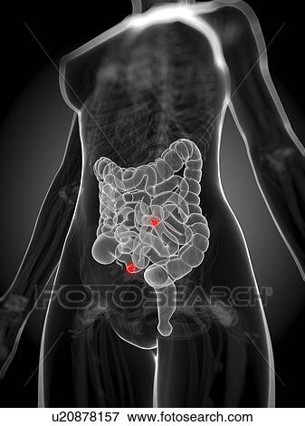 Intestinal cancer, artwork View Large Illustration Stock Illustration - Intestinal cancer, artwork. Fotosearch