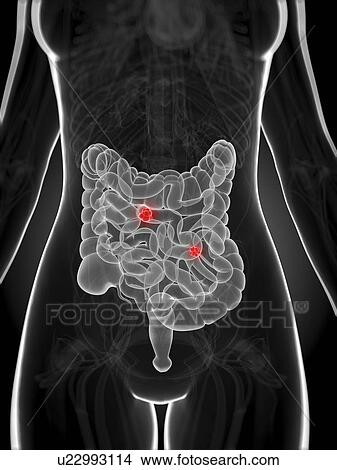 Stock Illustration - Intestinal cancer, artwork. Fotosearch