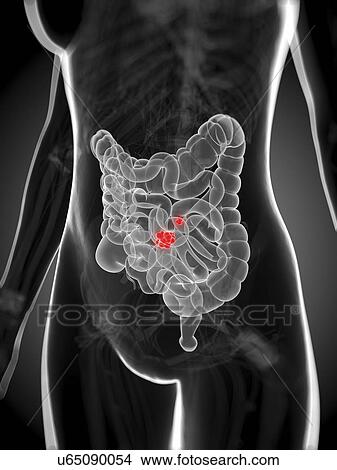 Stock Illustration - Intestinal cancer, artwork. Fotosearch